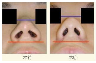 玻尿酸隆鼻效果怎么樣