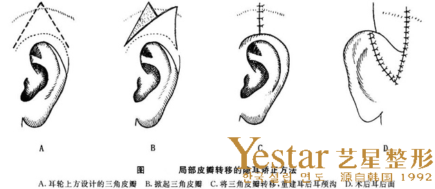 隱耳是什么樣的？隱耳癥能治嗎？