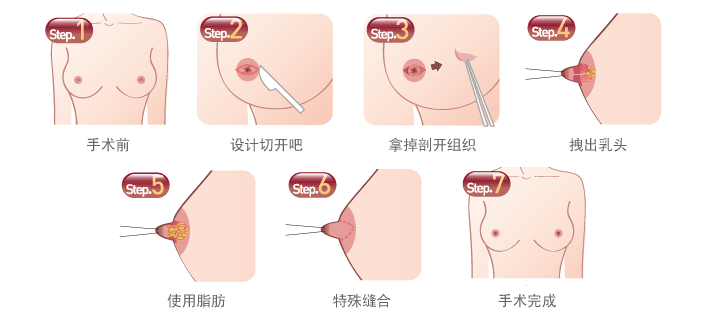 胸部整形過程