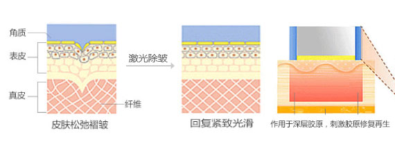 武漢激光除皺效果怎樣