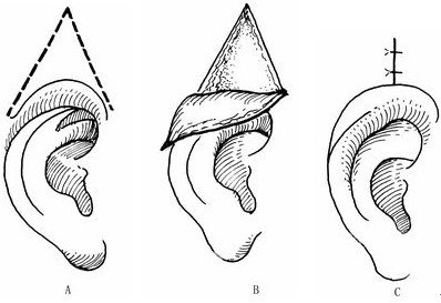 常用的有哪些隱耳整形手術(shù)