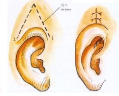 武漢外耳再造手術(shù)有效果嗎