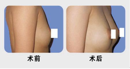 乳房再造對(duì)比圖