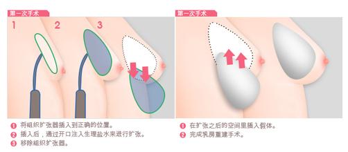 乳房再造過(guò)程