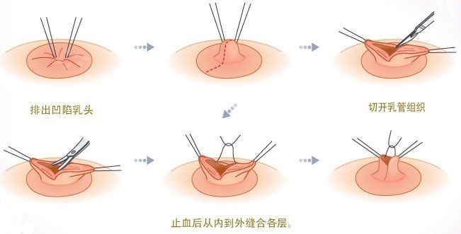 產(chǎn)后乳頭發(fā)生凹陷怎么辦