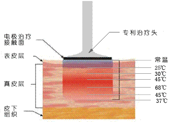 電波拉皮除皺效果怎樣