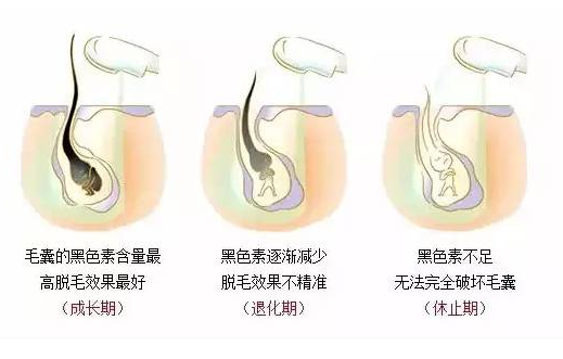 激光脫毛會有副作用嗎