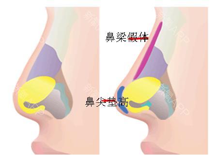 武漢取鼻假體效果好嗎