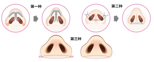 做鼻翼縮小術(shù)會(huì)留疤嗎