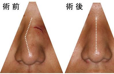 做歪鼻矯正影響健康嗎