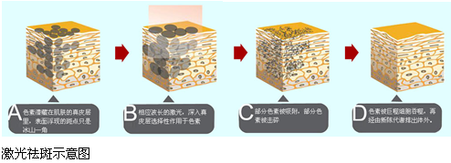 激光祛斑后不能曬太陽嗎