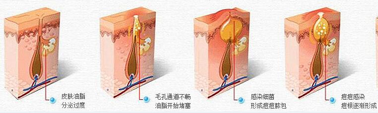 像素激光治療痘痘后怎么恢復(fù)的