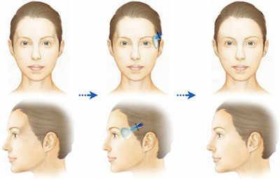 玻尿酸注射太陽穴