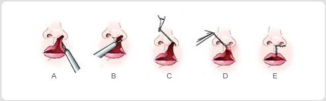 唇裂有什么辦法修復