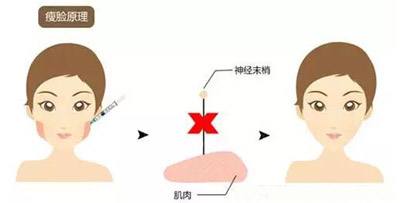 瘦臉后會(huì)咬肌無(wú)力嗎