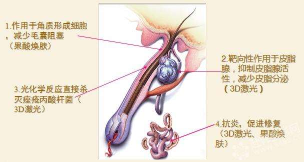 祛痘后會再次復(fù)發(fā)嗎