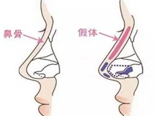 假體隆鼻過程是怎樣的