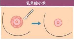 乳暈縮小術(shù)怎么做的