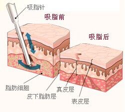 武漢臀部吸脂多少錢