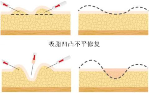 吸脂后凹凸不平怎么辦