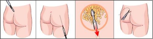 臀部吸脂是怎么做的