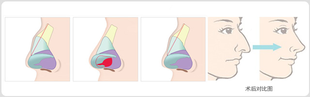 駝峰鼻矯正效果好嗎