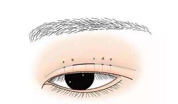埋線雙眼皮