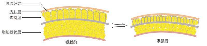 面部吸脂優(yōu)點有哪些