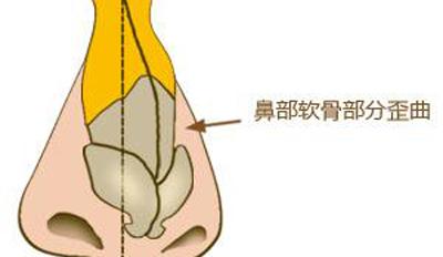 武漢哪些人不適合做歪鼻矯正