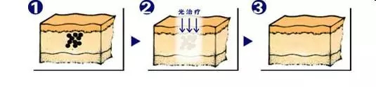 武漢祛黑斑需要多少錢呢