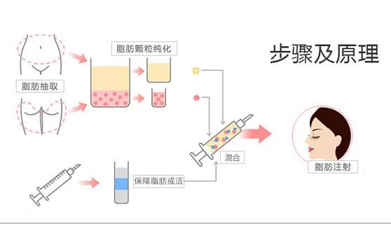 哪些部位可以填充自體脂肪