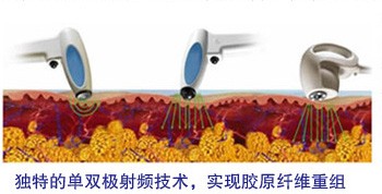 荊州射頻除皺費(fèi)用多少