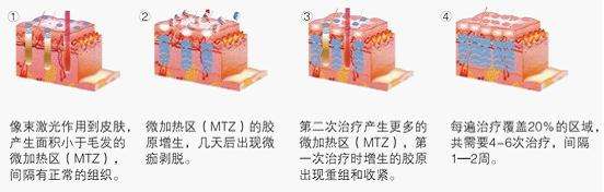 武漢激光美容嗎