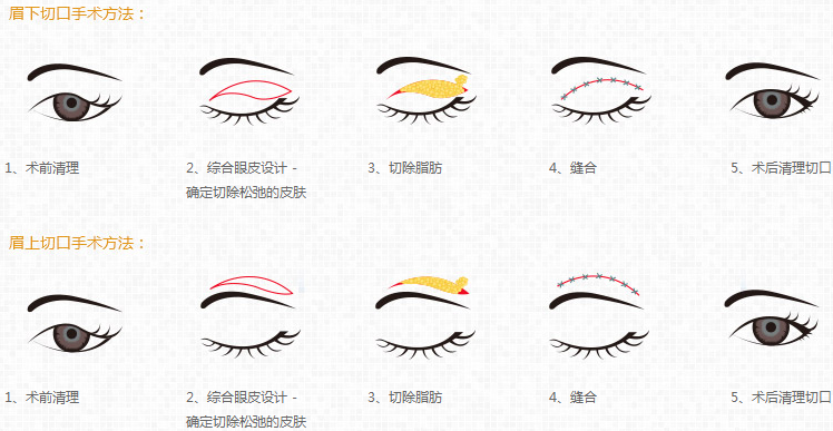 武漢眼瞼下垂怎樣矯正?