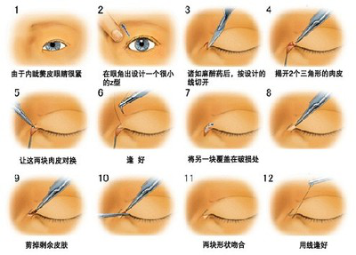 武漢內(nèi)眥贅皮矯正有哪些優(yōu)點(diǎn)?