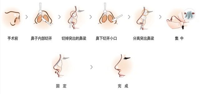 武漢鼻尖整形的方法有哪些?