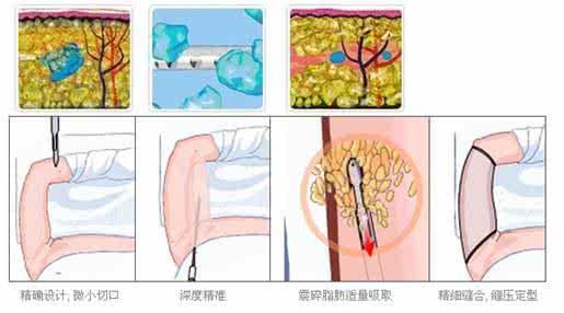 武漢腰腹部吸脂的效果如何?