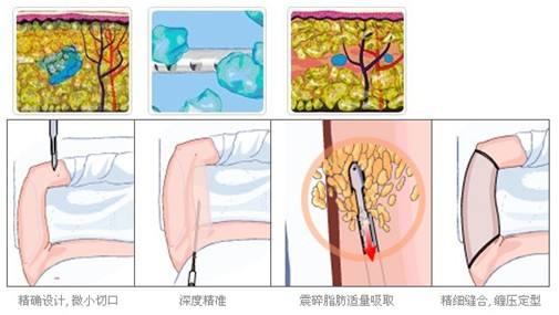 武漢手臂吸脂后怎么護理?