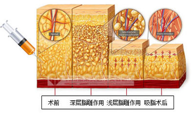 武漢背部吸脂手術(shù)多少錢?