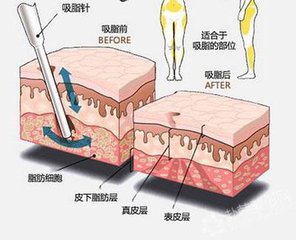 武漢產(chǎn)后吸脂減肥的價格是多少?