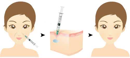 武漢玻尿酸去法令紋的價(jià)格是多少?