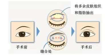 武漢做眼部吸脂會不會對眼睛造成傷害?