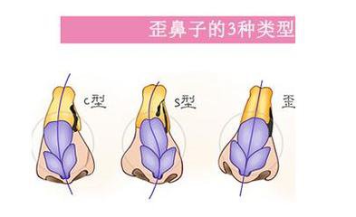 武漢歪鼻矯正的價(jià)格貴不貴?