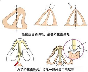 武漢歪鼻子整形的效果好不好?