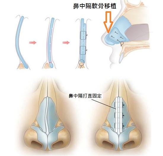 武漢歪鼻矯正手術(shù)價格是多少?