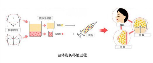 武漢自體脂肪隆鼻比較可靠的醫(yī)院?