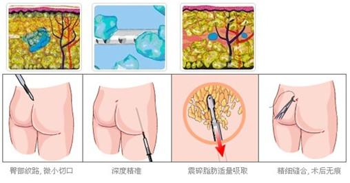 大腿吸脂需要注意的事情?