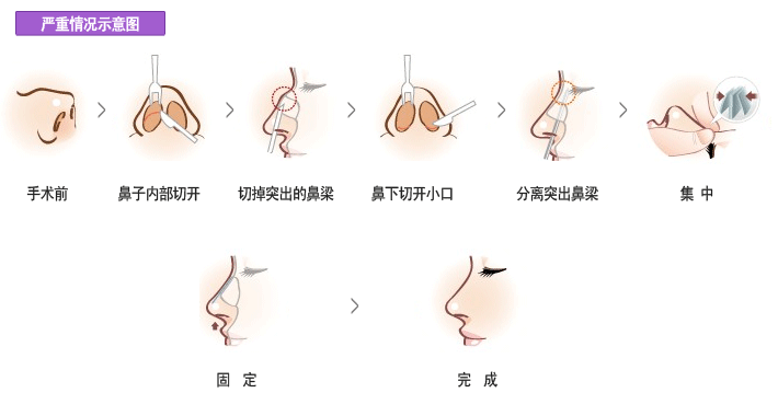 武漢駝峰鼻矯正術(shù)效果怎么樣?