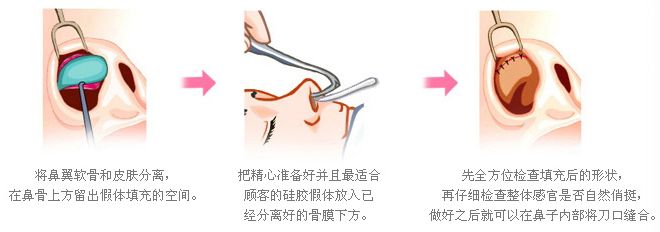 武漢隆鼻手術需要多久?