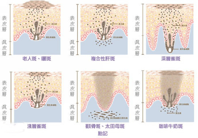 為什么會出現(xiàn)老年斑?